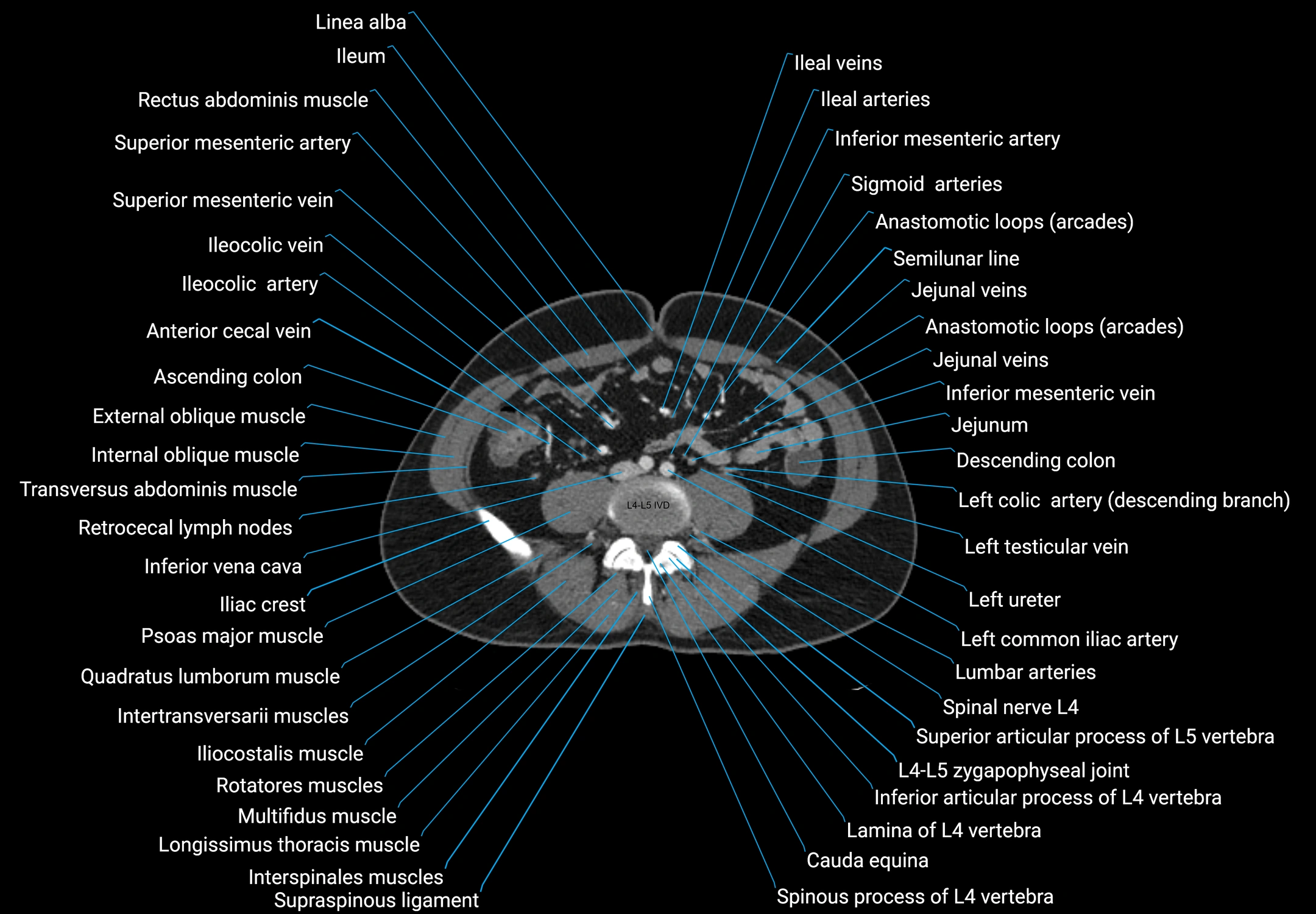 CT male pelvis axial cross sectional anatomy labelled radiology image -00116.webp